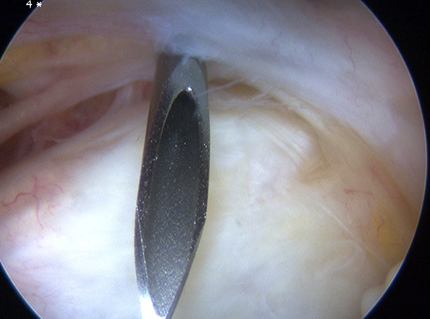 Elbow Scope Anterolateral Portal